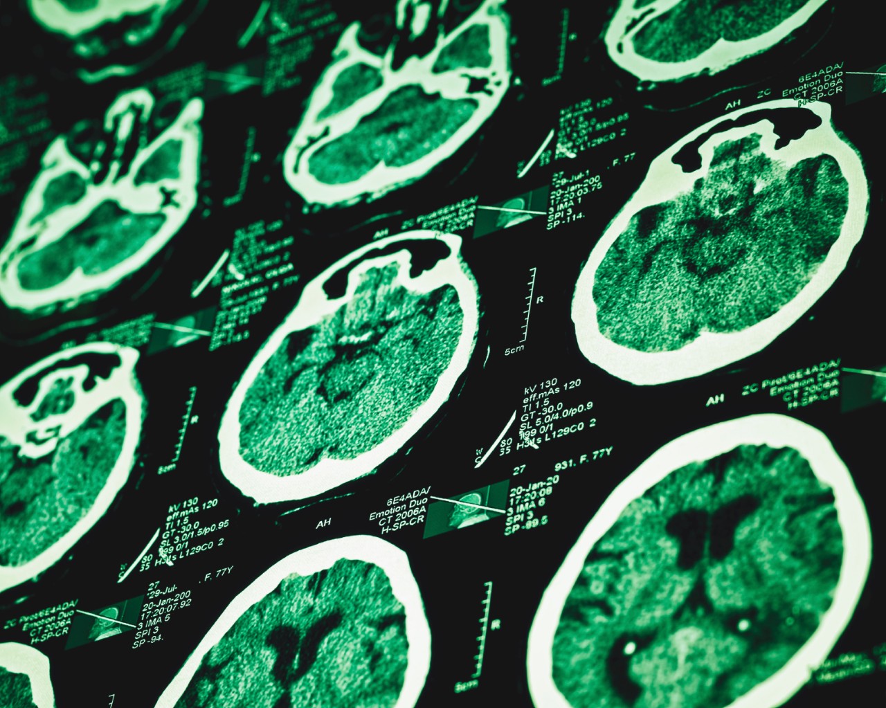 Brain scan