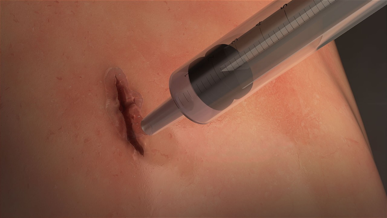 MeTro is squirted directly onto the wound and activated with light.